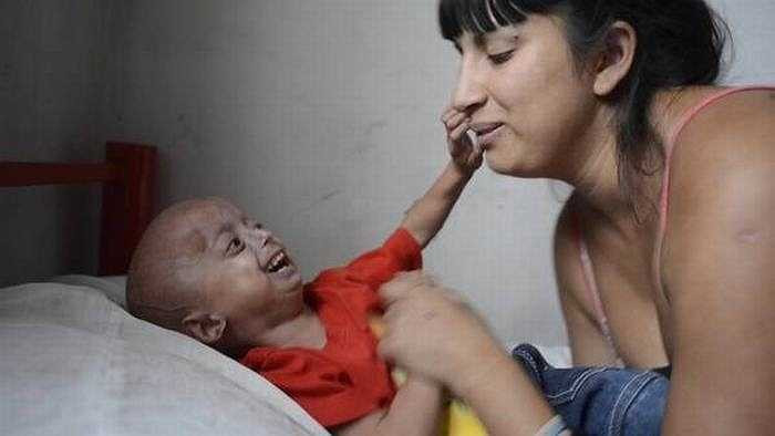 Một đứa trẻ bị Progeria khi lên 10 tuổi sẽ trông giống như cụ già với các triệu chứng: hói đầu, viêm khớp, các vấn đề về tim mạch... nhưng tâm trí thì vẫn như một đứa trẻ 10 tuổi bình thường.