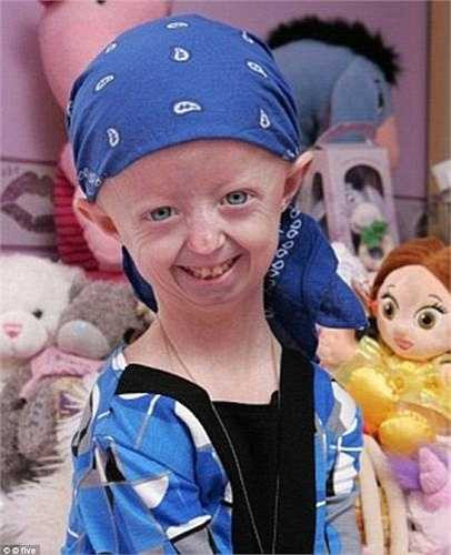 Một trường hợp khác là bé Hayley Okines ở Bexhill (nước Anh), em vừa qua đời tháng 4 vừa qua khi mới 17 tuổi. Cách đây 3 năm, Hayley được nhiều người biết đến sau khi xuất hiện trong một bộ phim tài liệu nói về căn bệnh lão hoá sớm.