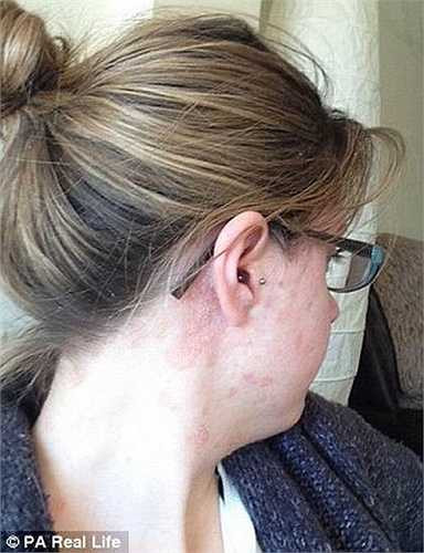 Năm 7 tuổi, Emma Jarvis đã mắc căn bệnh vẩy nến với rất nhiều nốt đỏ nổi khắp cơ thể. Emma luôn mặc quần dài và áo dài tay ngay cả vào mùa hè. Gia đình Emma bắt đầu tìm các liệu pháp để chữa trị cho cô bé. 