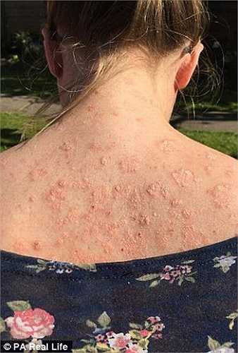 Khi Emma 18 tuổi, cô tìm đến liệu pháp trị bệnh bằng ánh sáng và căn bệnh vẩy nến bắt đầu được kiểm soát. 