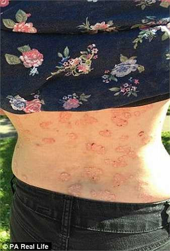 Nhưng đến cuối năm 2013, Emma lại rơi vào tuyệt vọng khi bệnh vẩy nến lại tiếp tục lan rộng khiến các mảng đỏ nổi khắp cơ thể cô.