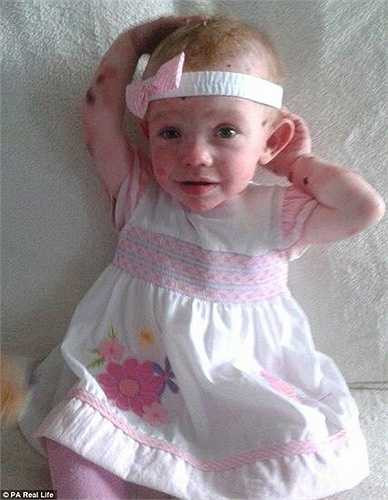 Bé Tia Price, 2 tuổi mắc một căn bệnh lạ được gọi là ‘hội chứng cánh bướm’ khiến cho làn da của bé cực kỳ mỏng manh với ánh sáng, nhiệt và sự va chạm.