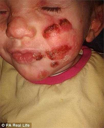 Chỉ cần chạm nhẹ cũng khiến da bé bị lở loét và nhiễm trùng.