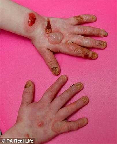 Cơ thể bé Tia cực kỳ nhạy cảm mọi sự tiếp xúc. Vì thế, mẹ cô bé, Annemarie Price, 22 tuổi, có thể sẽ chẳng bao giờ được ôm con gái mình khi bé chưa cuốn băng kín người. 