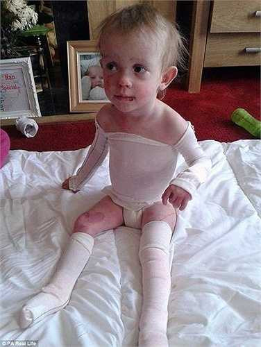 Từ khi sinh ra, Tia đã không có da chân. Khi lớn lên một chút, da của bé bắt đầu xuất hiện những chất dịch trên bề mặt. Bé Tia không thể đi bộ do mụn nước trên đôi chân của mình.