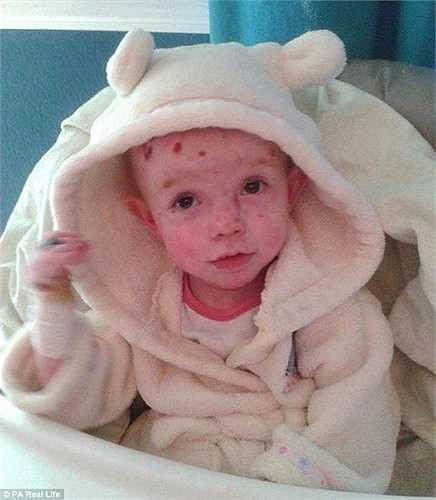 ‘Mỗi buổi sáng tôi phải thay băng trên chân và tay Tia. Bé phải được băng bó như vậy vì da rất nhạy cảm. Sau đó, tôi phải kiểm tra phần còn lại của cơ thể bé. Thường là tôi phải băng bó tay, ngón tay, cánh tay và lưng của Tia’, chị Annemarie chia sẻ.