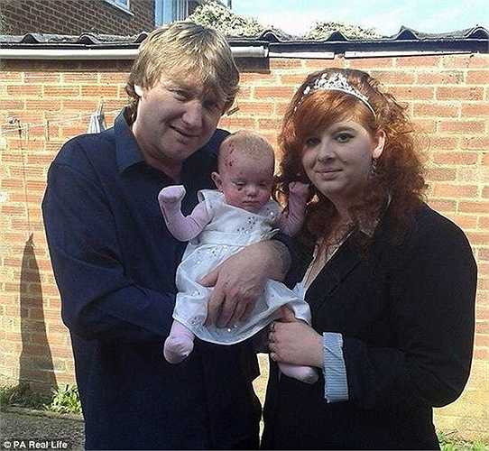 Làn da quá mỏng manh khiến toàn thân bé Tia phồng rộp và rất dễ bị lở loét, cô bé phải thường xuyên sử dụng morphine để giảm đau. 