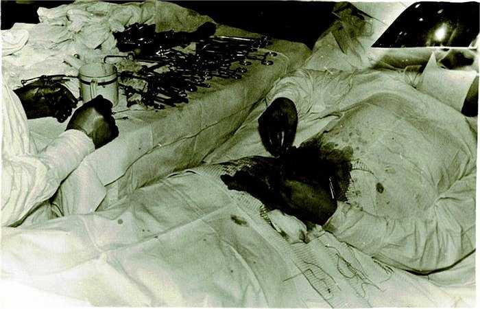 Anh mất khá nhiều máu, cứ 4-5 phút, bác sỹ lại phải nghỉ 20-25 giây để lấy sức rồi cắt bỏ phần ruột thừa và tự tiêm thuốc kháng sinh vào khoang bụng.