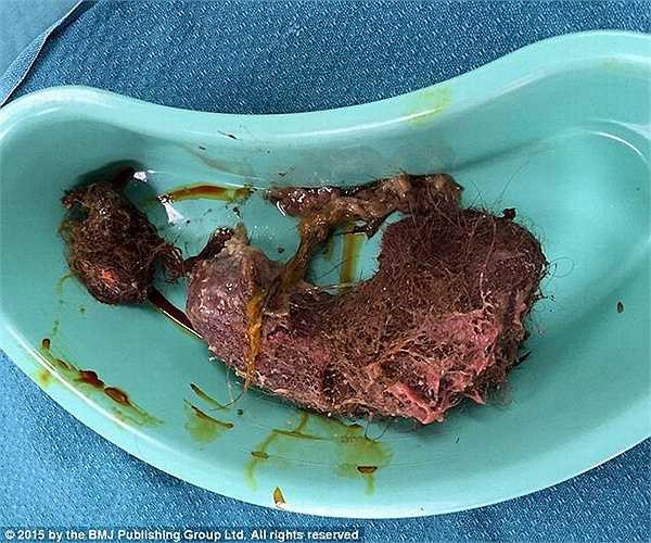 Người nhà bé gái cho biết, em có thói quen bứt tóc của mình và ăn. Thời gian gần đây, bé bắt đầu biếng ăn hay nôn. 