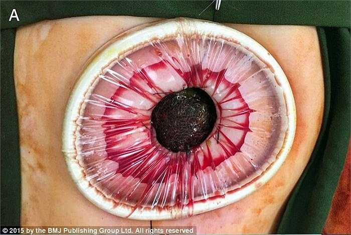 Sau đó, các bác sỹ đã tiến hành mổ lấy búi tóc và bệnh nhi sẽ được điều trị hành vi để không nhổ và ăn tóc của mình.