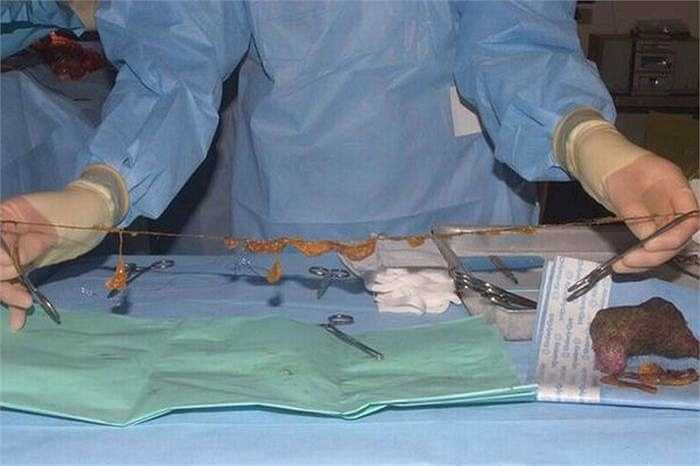 Phải mất 6 tiếng đồng hồ, các bác sỹ mới lấy hết được búi tóc và những đoạn tóc còn vướng vào các cơ quan khác trong hệ tiêu hóa. 