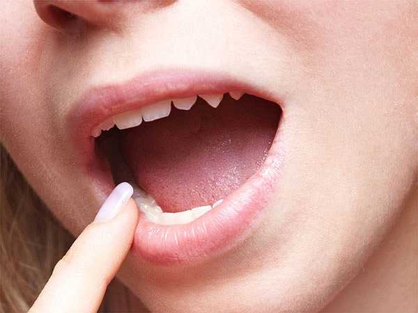 Loét miệng: Muối cũng có thể chữa lành vết loét miệng. Bạn chỉ cần áp một chút muối trên diện tích bị loét trong miệng. Dù rằng phương pháp này có thể khiến bạn hơi đau và xót miệng nhưng bạn nên giữ nguyên trong vài phút. Áp dụng phương pháp này trong một vài ngày để nhận thấy hiệu quả.