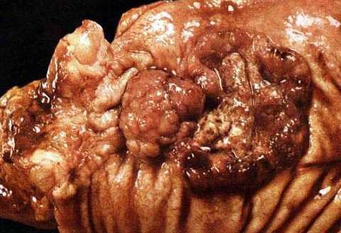 Đừng để viêm loét dạ dày biến chứng ung thư