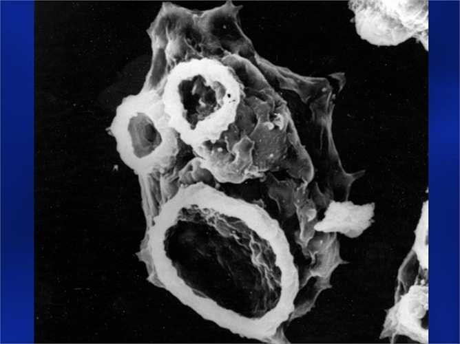Ký sinh trùng ăn não người Amip. Loài ký sinh trùng này có thể xâm nhập não người từ dưới nước. Sau đó sinh sống và khiến cho người bệnh bị đau đầu, tổn thương vùng trong đầu trầm trọng. Cuối cùng là một cái chết đau đớn đang chờ đợi