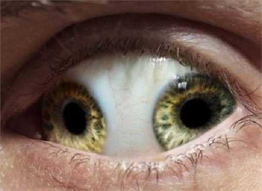 Một người đàn ông ở Trung Quốc có đôi mắt kỳ quái khi sở hữu 2 đồng tử trong một bên mắt. Mặc dù, căn bệnh này không được tìm thấy trong các tài liệu y học, nhưng theo truyền miệng, người đàn ông này là một vị quan lớn trong triều đại Trung Quốc phong kiến năm 995 sau Công nguyên.