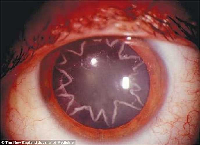 4 tuần sau khi bị một nguồn điện mạnh tới 14.000 volt gây sốc vào vai, một người thợ điện 42 tuổi sống tại California, Mỹ đã tới bác sỹ để khám mắt vì cảm thấy thị lực của mình giảm đi đáng kể. Bác sỹ đã chụp lại tấm hình khiến người thợ điện choáng váng: một ngôi sao nhiều cánh đã hiện lên trong con ngươi của anh.