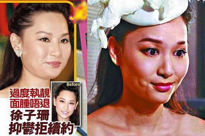 Người đẹp TVB Từ Tử San gây sốc với gương mặt sưng phồng. 