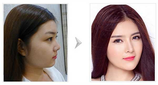 Trước thẩm mỹ, mũi của Lilly Luta đẹp nhưng cô vẫn muốn tăng thêm độ hoàn hảo bằng việc dùng tới dao kéo.