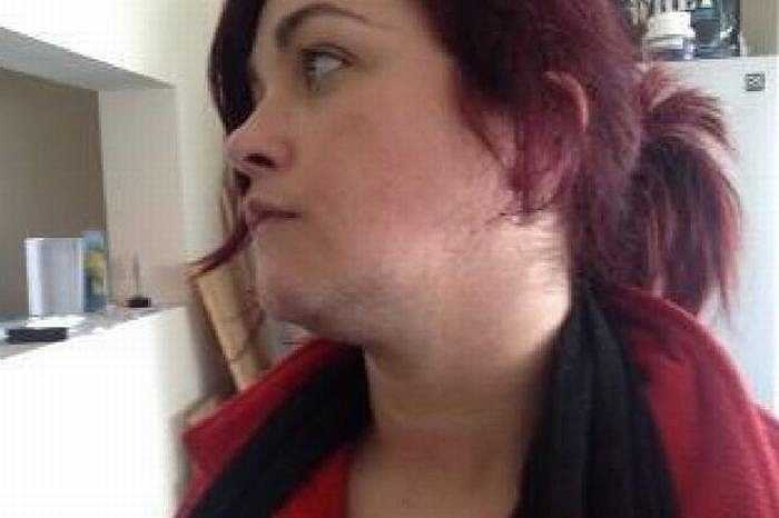 Cheryl Howe (32 tuổi) sống tại Morcecambe (Anh) bị mắc hội chứng đa nang buồng trứng (PCOS) khiến lông ở vùng mặt, ngực, bụng và chân cô phát triển mạnh.