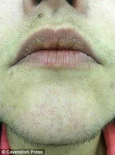 Năm 12 tuổi, lông trên ngực và chân bắt đầu mọc dài và phát triển nhiều khiến cô bé Cheryl bị gán cho biệt danh ‘Gorilla Cheryl’.