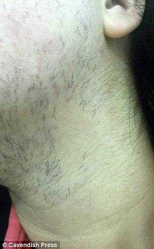 Khi đến khám tại bệnh viện, các bác sỹ chẩn đoán Cheryl mắc hội chứng PCOS và kê cho cô uống thuốc tránh thai để điều trị bệnh nhưng không có tác dụng. Anh trai John của Cheryl phải dạy cô cách cạo râu hàng ngày.