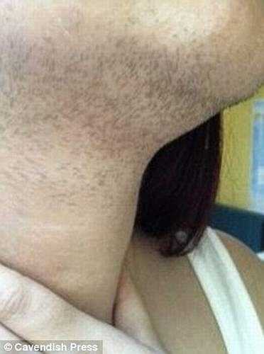 Cheryl đã mất 6 năm điều trị liên tục tại các trung tâm y tế và chi khoảng 2.000 bảng mỗi năm để mua dao cạo để cạo râu 3 lần/ngày. 