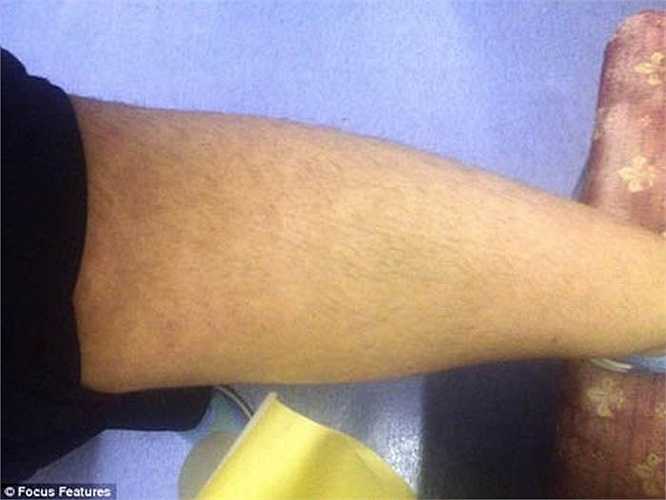 'Lông, tóc mọc quá nhanh khiến các mối quan hệ của tôi bị hủy hoại. Tôi thậm chí còn không cảm thấy mình là một người phụ nữ’, Cheryl chia sẻ.