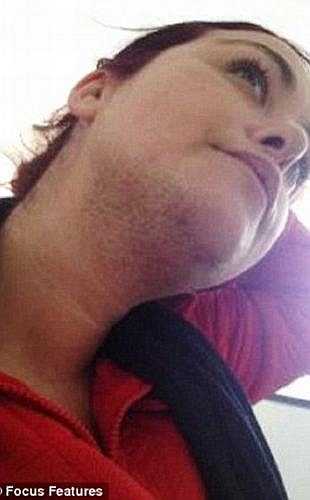 Nhưng cuộc hôn nhân của Cheryl đã đổ vỡ do chồng cô không thể chịu nổi căn bệnh kỳ lạ của vợ. Việc này khiến Cheryl mặc cảm nên đã bỏ việc và ngại ngùng mỗi khi ra ngoài.