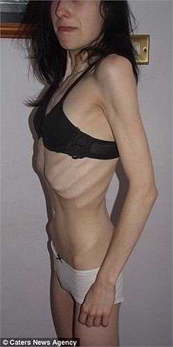 Chứng rối loạn ăn uống khiến Jade chán ăn và sụt cân nghiêm trọng. Jade cao 1m60 nhưng chỉ nặng gần 32kg.