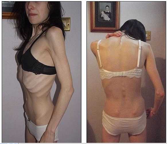 Sau đó, Jade đã không thể nhận ra mình khi nhìn lại những bức ảnh ngày trước, tôi không thể tin được mình có thể sống sót khi tự bỏ đói chính mình. 