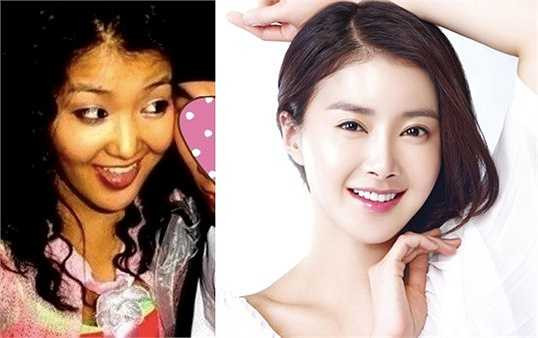 Trong 10 năm qua, Lee Si Young đã trải qua rất nhiều lần phẫu thuật thẩm mỹ. Tuy nhiên, ngôi sao Cô dâu xinh đẹp của tôi khá thoải mái với vấn đề này. Lee Si Young cho biết, cô vẫn luôn nghĩ đây là gương mặt tự nhiên của mình. Khi được hỏi lý do thừa nhận, nữ diễn viên 33 tuổi phát biểu: 'Vì trông tôi giống người phẫu thuật thẩm mỹ. Hơn nữa, tôi không có lý do gì để giấu giếm'.