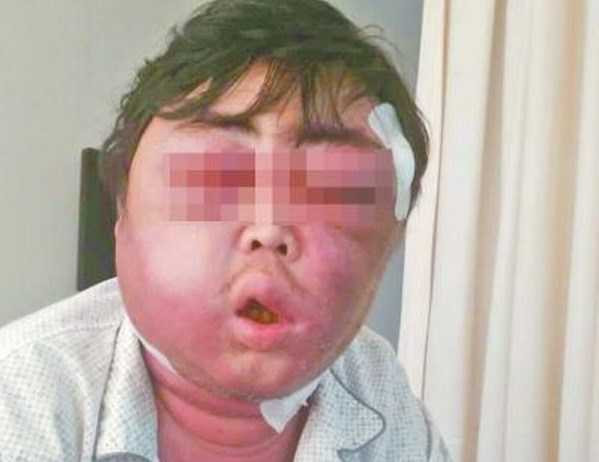 Anh Trương với khuôn mặt biến dạng