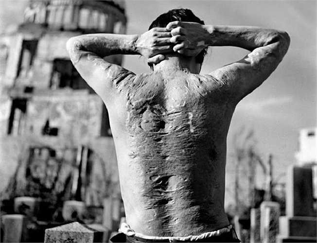 Một nạn nhân bom nguyên tử ở thành phố Hiroshima