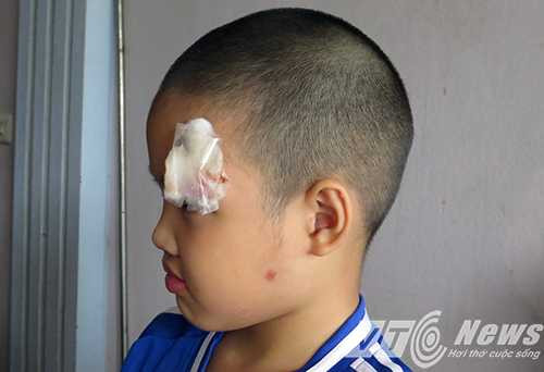 Cháu Lê Xuân Phúc Thắng (gần nhà chị Huyên) bị thương ở gần mắt trái - Ảnh MK