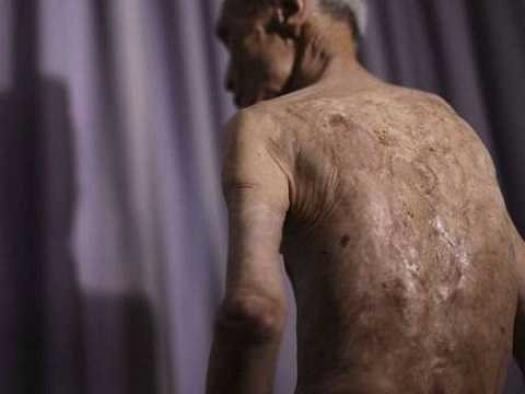 Cụ ông Sumiteru Taniguchi, một trong số những người sống sót sau vụ ném bom nguyên tử của Mỹ xuống Nagasaki Cụ ông Sumiteru Taniguchi, một trong số những người sống sót sau vụ ném bom nguyên tử của Mỹ xuống Nagasaki