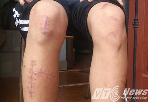 Hai chân Duy với hàng loạt vết dao chém - Ảnh MK Hai chân Duy với hàng loạt vết dao chém - Ảnh MK