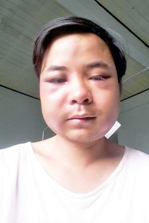 Mặt anh Hà bị đánh sưng vù. Mặt anh Hà bị đánh sưng vù.