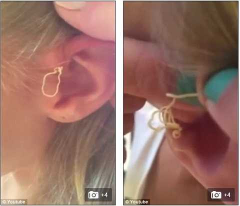 Càng nặn, mủ tiếp tục chảy ra như con giun quằn quại.