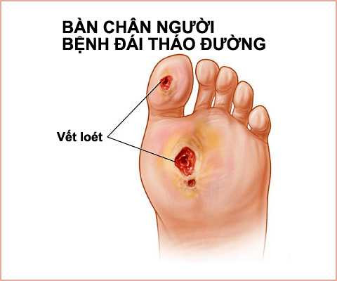 Bệnh đái tháo đường dễ gây ra nhiều biến chứng, dễ có vét loét ở chân lâu lành.