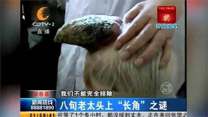 Hiện tại, chiếc sừng đã dài gần 13cm, có đường kính 5cm. Cái sừng này có hình dáng và màu sắc giống của sừng động vật. Tuy nhiên, vùng da xung quanh xừng có màu đỏ tươi và thỉnh thoảng rỉ máu.