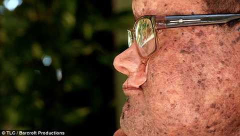 Anh Deide với phần vòm miệng giả cấy ghép để có thể nói được