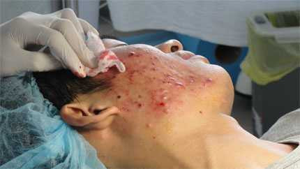 Thực hư tin lan truyền nam thanh niên Hà Nội chết vì nặn mụn