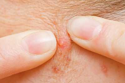 Tự nặn mụn khiến nhiễm trùng máu: Gia đình xin về nhà lo hậu sự