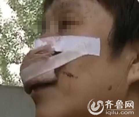 Người phụ nữ bị chồng cắn nát mũi chỉ vì không nghe điện thoại của ông ta Người phụ nữ bị chồng cắn nát mũi chỉ vì không nghe điện thoại của ông ta