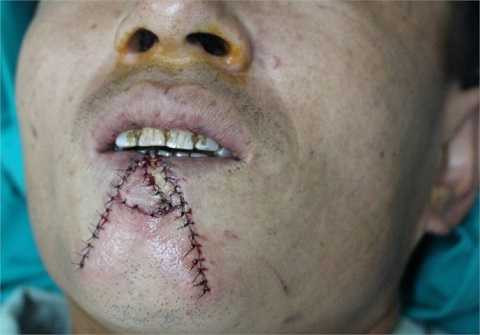 Bệnh nhân sau phẫu thuật Bệnh nhân sau phẫu thuật