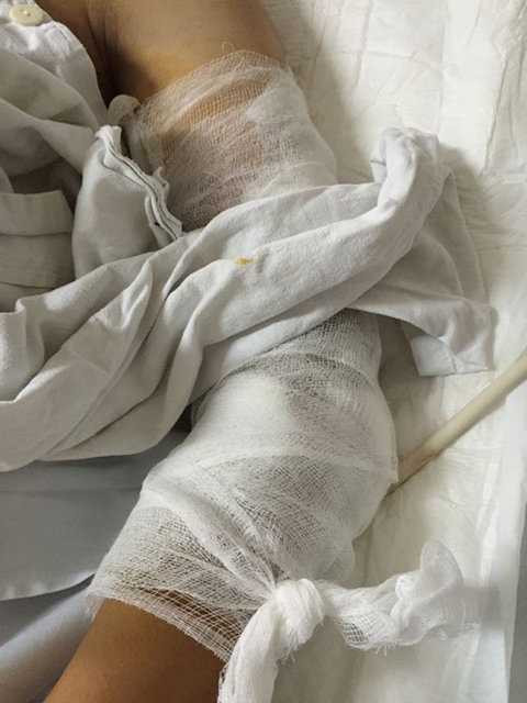 Lâm bị thương ở cánh tay trái phải băng bó