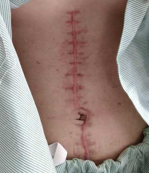 Vết mổ dài trên bụng H. Vết mổ dài trên bụng H.