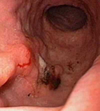 Viêm loét dạ dày có thể biến chứng nguy hiểm.