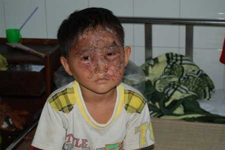Bé Huy bị bỏng đang điều trị tại bệnh viện