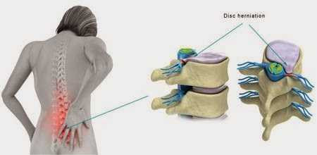 Bệnh thần kinh cột sống phổ biến ở dân văn phòng.